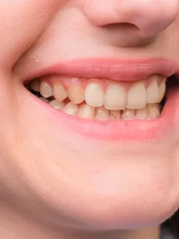 tooth discolouration 4 - unsplash (1)