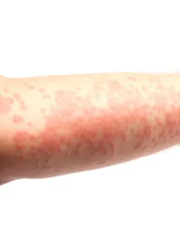 Skin allergy 3 - unspalsh (1)