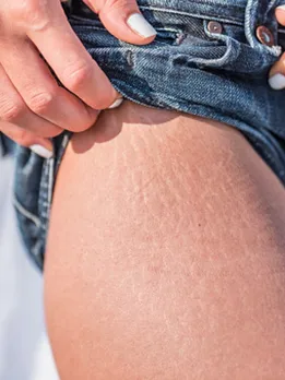 cellulite 2 - unsplash (1)