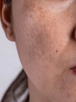 skin pigmentation 4 - unsplash (1)