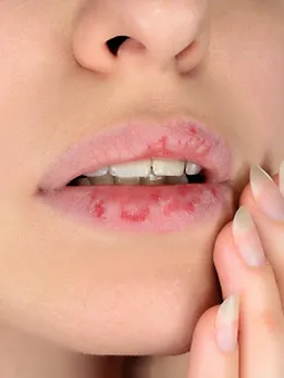 dry lips 1 - unsplash (1)
