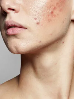 acne 1 - unsplash (1)