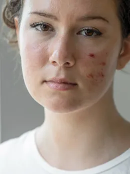 acne 2 - unsplash (1)