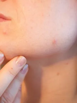 acne-1606765__340 (1)