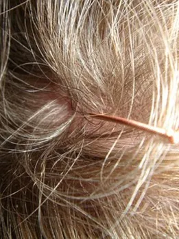 acupuncture-289252__340 (1)