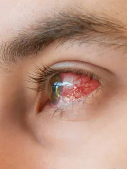 Eye flu, eye flu cases, eye flu symptoms, health news, healthcare news,