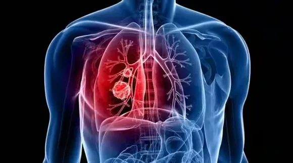 World Lung Cancer Day 2023
