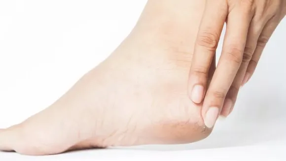 cracked heels