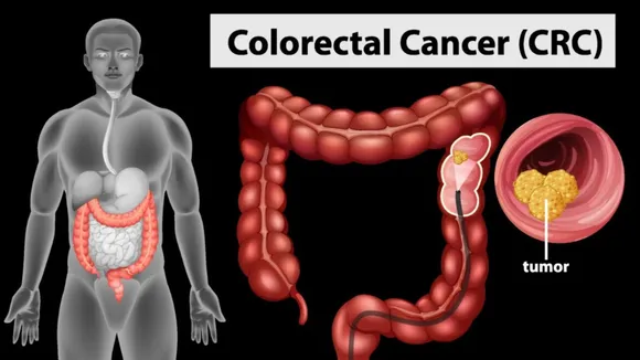 Colorectal Cancer