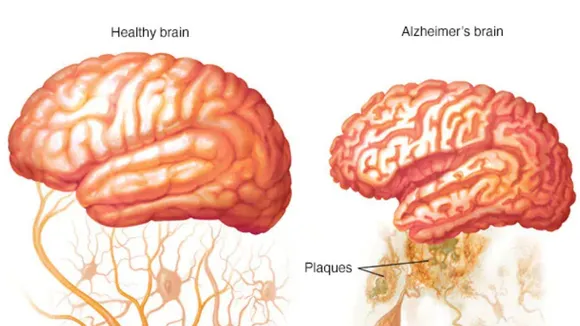 alzheimer's disease