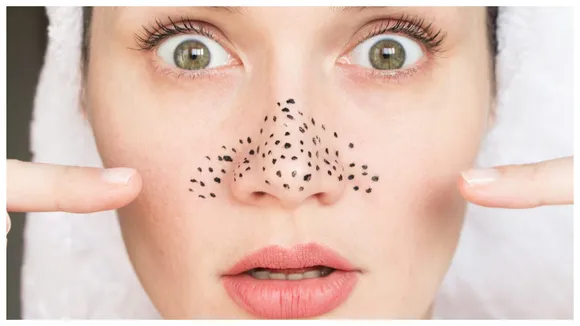 Blackheads