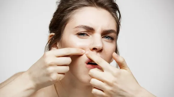 pimples, skin care tips