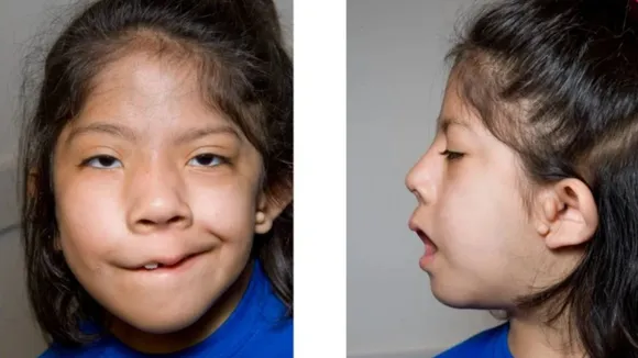 goldenhar syndrome