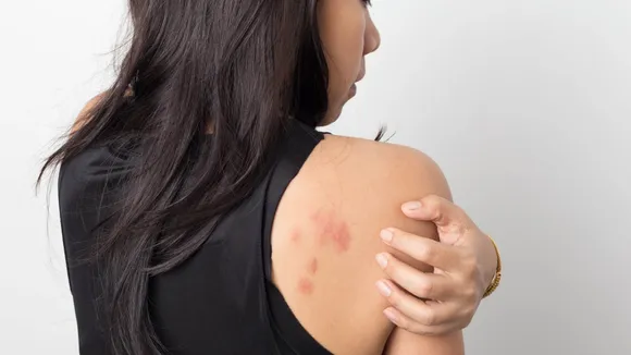 rashes 