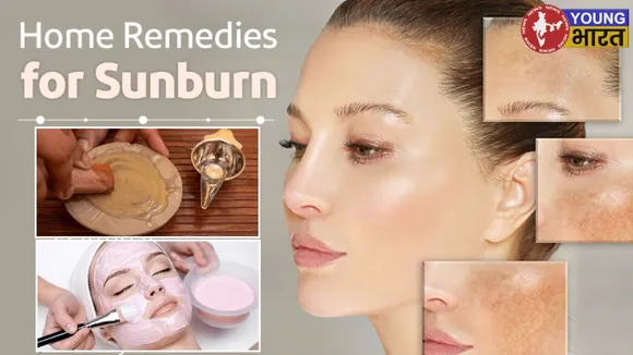 SunBurn Remedies