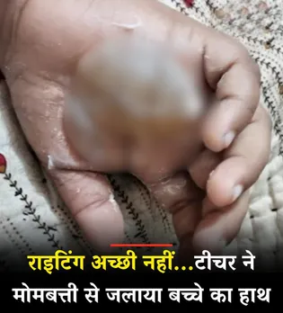 8 साल के मासूम का जलाया हाथ, टीचर की खौफनाक सजा! | यंग भारत न्यूज