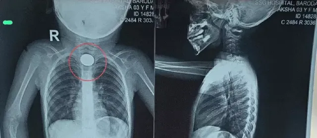 Panic in Vadodara as Two Children Swallow Paper Pin and Coin, Emergency ENT Surgeries Save Lives