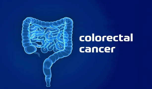કોલોન કેન્સરનું યુવાનોમાં વધ્યું જોખમ, હેલ્થ એક્સપર્ટે આપી ચેતવણી