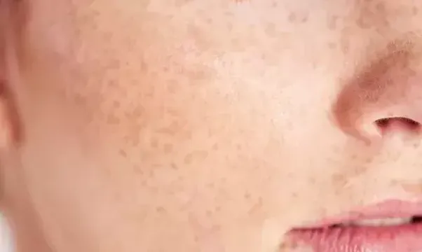 હાઈપરપીગ્મેન્ટેશનની સમસ્યાને દૂર કરવા માટે મધ ખૂબ જ છે અસરકારક, આ રીતે કરો તેનો ઉપયોગ...