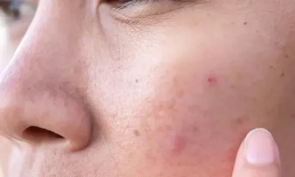 ચહેરા પરની ફોલ્લીઓ અને ડાઘ દૂર કરવા માંગો છો, તો આ ઘરે જ બનાવો સ્ક્રબ્સ