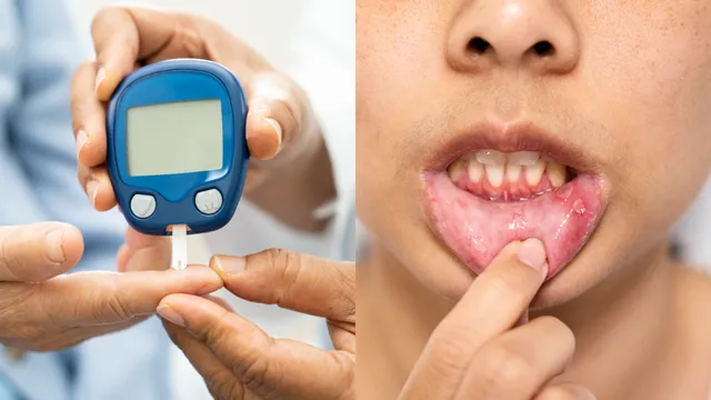Diabetes: మధుమేహం ఉన్నవారికి ఈ అల్సర్లు తప్పవు