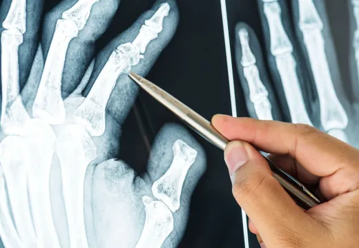 ఎముకలను ఇనుములా మార్చే పండు