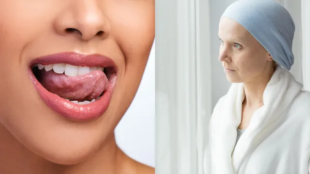 Tongue Vs Cancer: నాలుకపై ఎరుపు, తెలుపు మచ్చలు క్యాన్సర్ సంకేతమా?