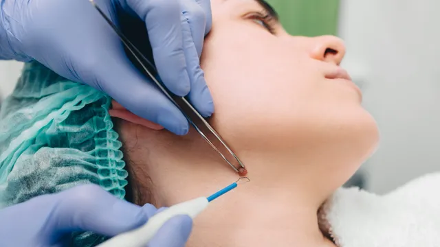Neck Warts: మెడపై వార్ట్స్‌ని ఇలా సులభంగా తొలగించుకోండి