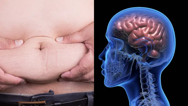 Obesity: బాగా లావు ఉంటే మెదడు పని చేయదా..?
