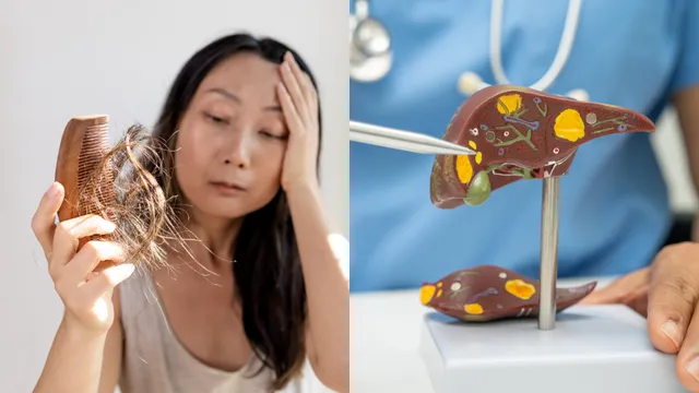 Liver Vs Hair: కాలేయ ఆరోగ్యానికి జుట్టు రాలడానికి సంబంధం ఏంటి...?