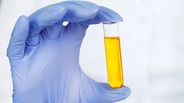 Urine: మూత్రం చుక్కచుక్కగా.. చుక్కలు చూపిస్తుందా..? ఆ అవయవం పని చేయనట్టే వెంటనే..!!