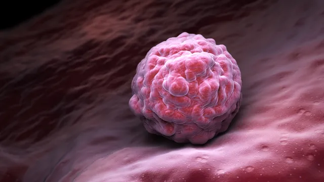 Cancer lump: క్యాన్సర్ గడ్డ నొప్పిని కలిగిస్తుందా..? ఈ లక్షణాలుంటే వెంటనే జాగ్రత్త