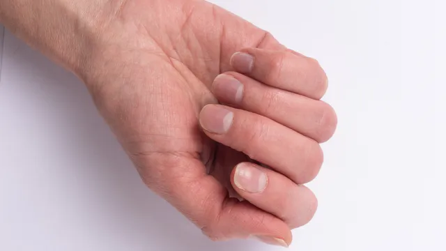 Nails Scratches: గోళ్లపై గీతలు దేనిని సూచిస్తాయో తెలుసా..? కారణాలు తెలుసుకోండి
