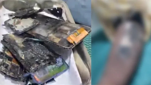 VIVO Phone Blast: ప్యాంటు జేబులో పేలిన VIVO ఫోన్.. తొడంతా కాలిపోయింది!