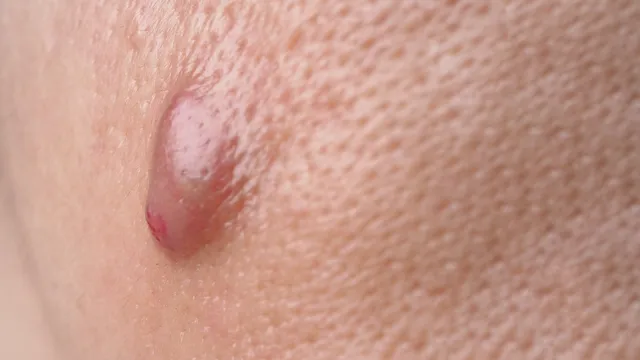 Open pores: చర్మంపై ఓపెన్ పోర్స్‌తో ఇబ్బంది ఉందా..? ఈ చిట్కాలు ట్రై చేస్తే సమస్య పరార్