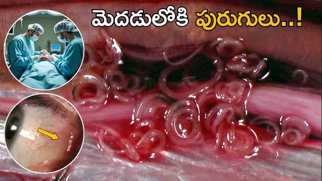 Worm in Human Eye: కన్ను నుంచి మెదడులోకి వెళ్లిన పురుగు..! డాక్టర్లు షాక్..