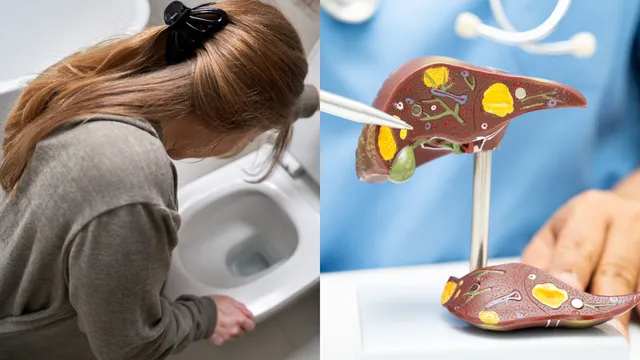 Liver Diseases: మల విసర్జన సమయంలో ఇలాంటి లక్షణాలు కనిపిస్తే కాలేయం దెబ్బతిన్నట్లే