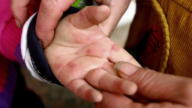 Tomato Virus: టమోటా వైరస్‌ కలకలం.. చిన్నారుల్లో పెరుగుతున్న వ్యాప్తి