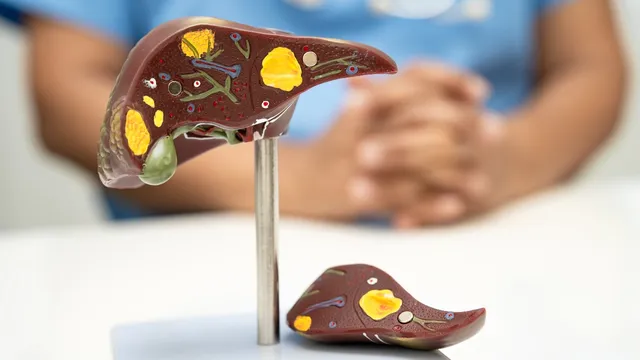 Fatty Liver: బరువు తగ్గించుకోండి.. కాలేయ వ్యాధుల బారిన పడకుండా ఉండండి!!
