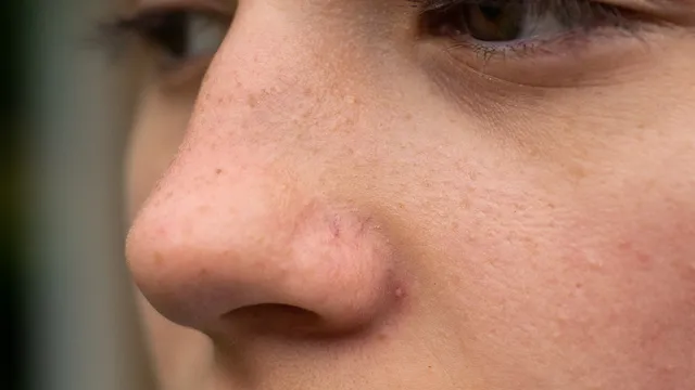 Face Blackheads: బ్లాక్ హెడ్స్ మీ ముఖం అందాన్ని తగ్గిస్తున్నాయా..? అయితే వైద్యులు సూచించే ఈ ఇంటి చిట్కా ట్రై చేయండి!!