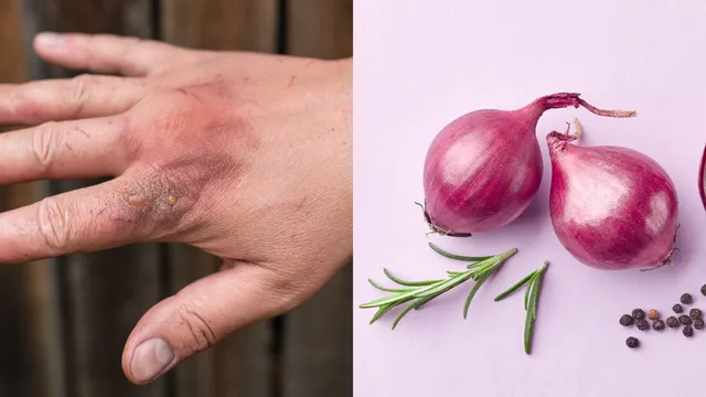 Health Tips: బ్లాక్ ఫంగస్ ఉన్న ఉల్లిగడ్డలు తింటే ఎంత డేంజరో తెలుసా..?