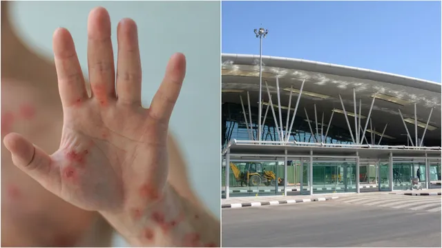Mpox ఎఫెక్ట్.. బెంగళూరు విమానాశ్రయంలో 2,000 మందికి పరీక్షలు!
