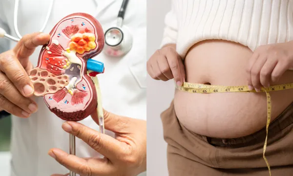 Kidney: ఊబకాయంతో కిడ్నీ సమస్యలు తప్పవా..?