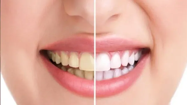 Health Tips: పళ్లపై పసుపు మరకలు పోవాలంటే ఇలా చేస్తే సరి..