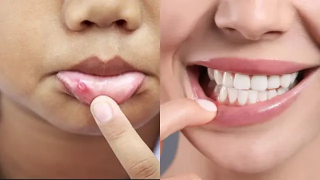 Mouth Ulcers: ఈ చిన్న చిట్కాతో నోటిపూత మాయం.. అదేంటో తెలుసుకోండి!