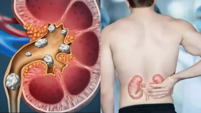 Kidney Stones: కిడ్నీలో రాళ్లు ఉన్నాయా?..వీటిని అస్సలు తినకండి