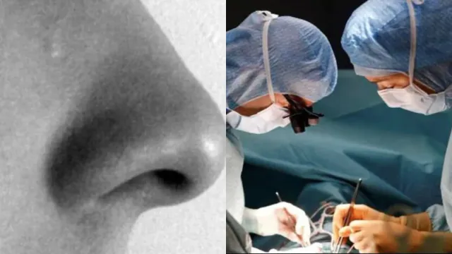 Viral News: ముక్కు కాదు.. కీటకాల పుట్టా.. ముక్కులో 150 పురుగులను చూసి డాక్టర్లు షాక్!
