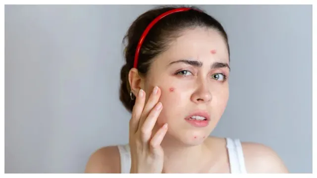 Health: మొటిమలు వదిలించుకోవడానికి కొన్ని చిట్కాలు!