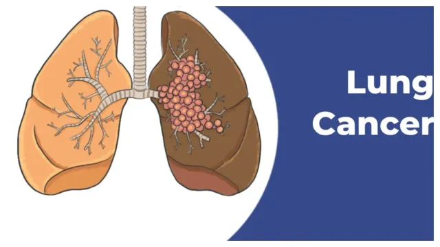 Lung Cancer: స్మోక్ చేయకపోయిన లంగ్ క్యాన్సర్!
