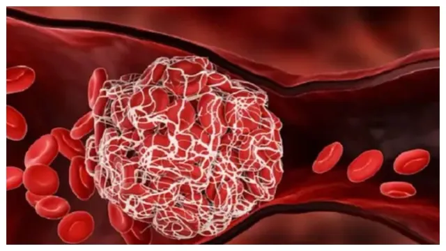 Health : శరీరంలో రక్తం గడ్డ కడితే.. మనలో కనిపించే లక్షణాలు ఇవే!